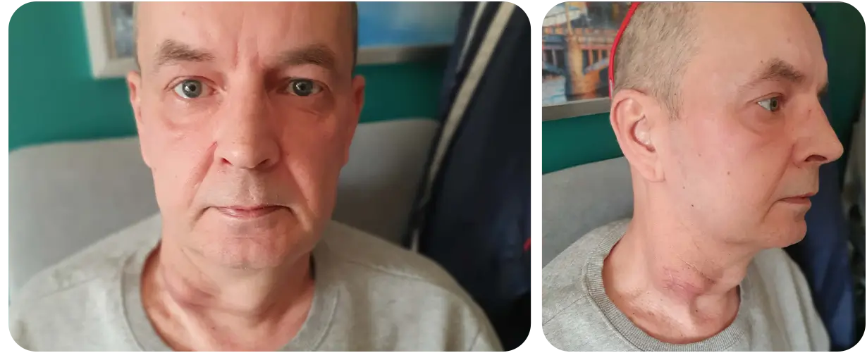 Marcin Stochmal - zbiorka na leczenie